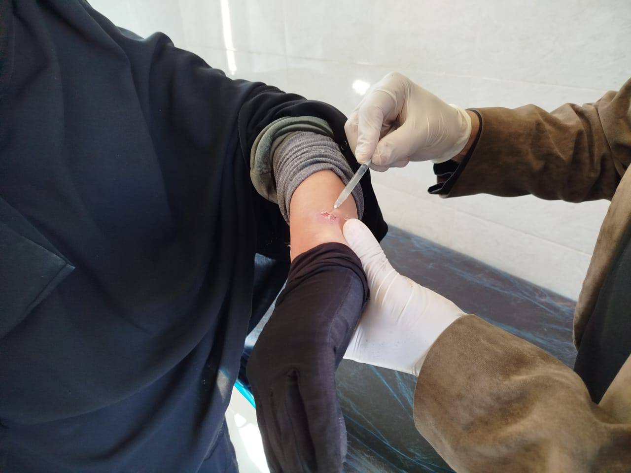 انخفاض إصابات اللشمانيا في منطقة "الهيشة" بنسبة 80%